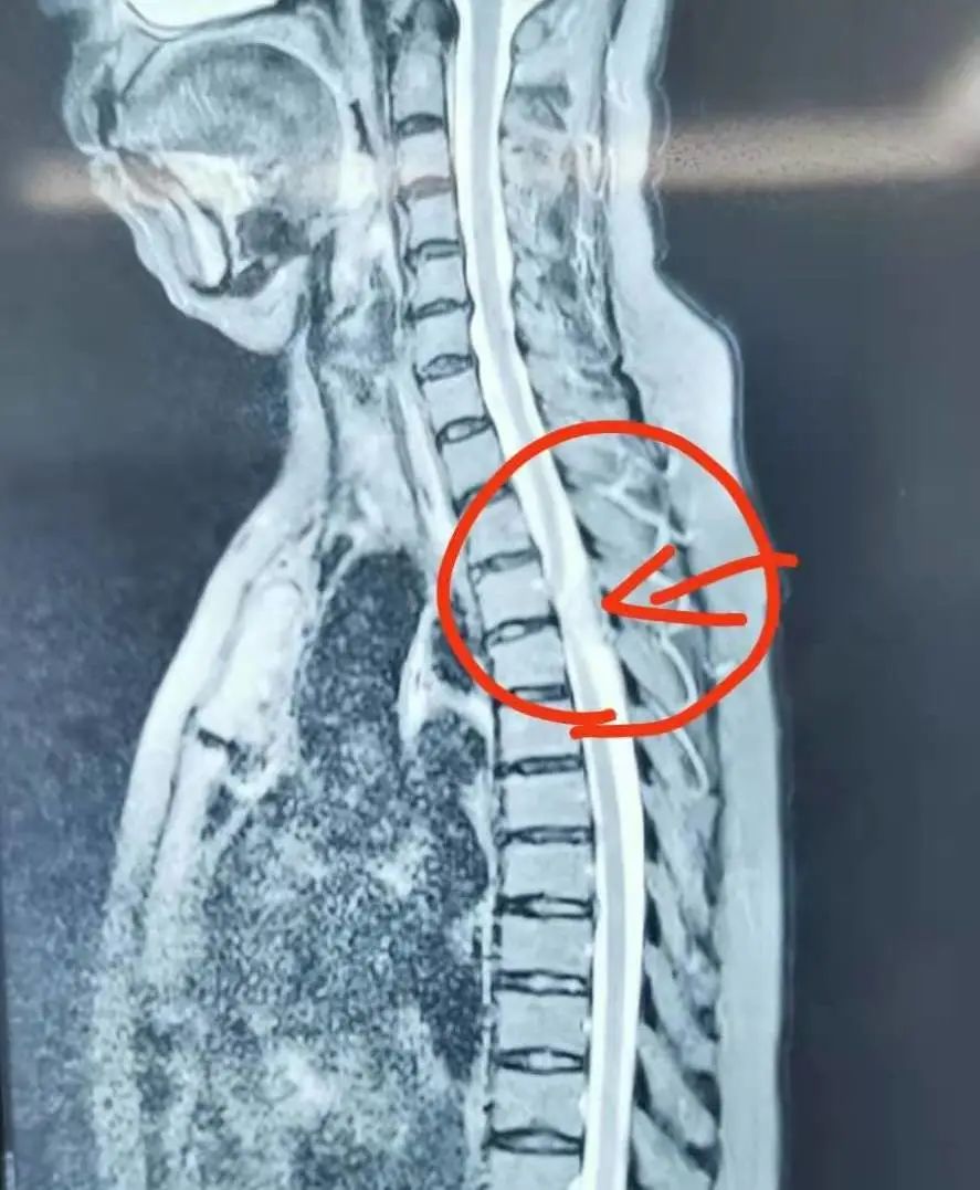 脊膜瘤险致下肢瘫痪，神外、骨科强强联手迎刃而解