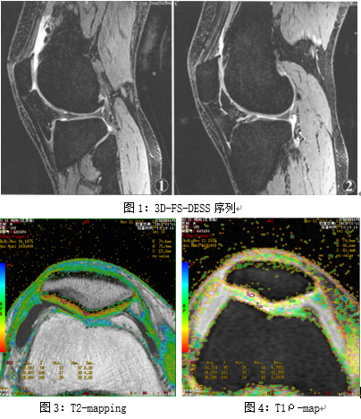 磁共振 3D-FS-DESS 序列联合 T2-mapping 及 T1ρ技术对关节软骨病损的临床应用