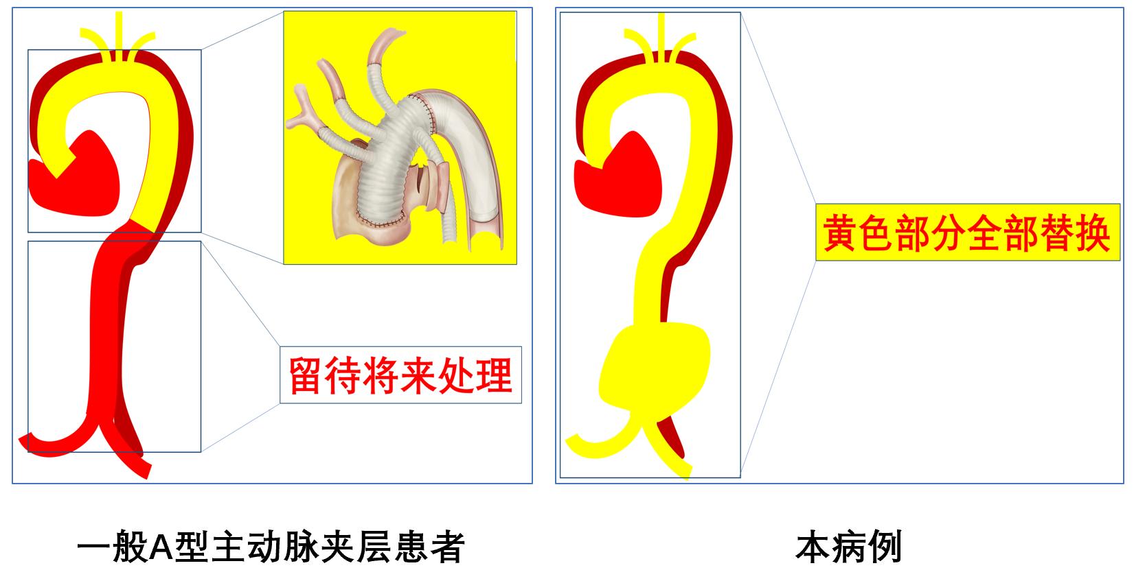创造生命奇迹：近 1 米长的人体大动脉血管被全部替换
