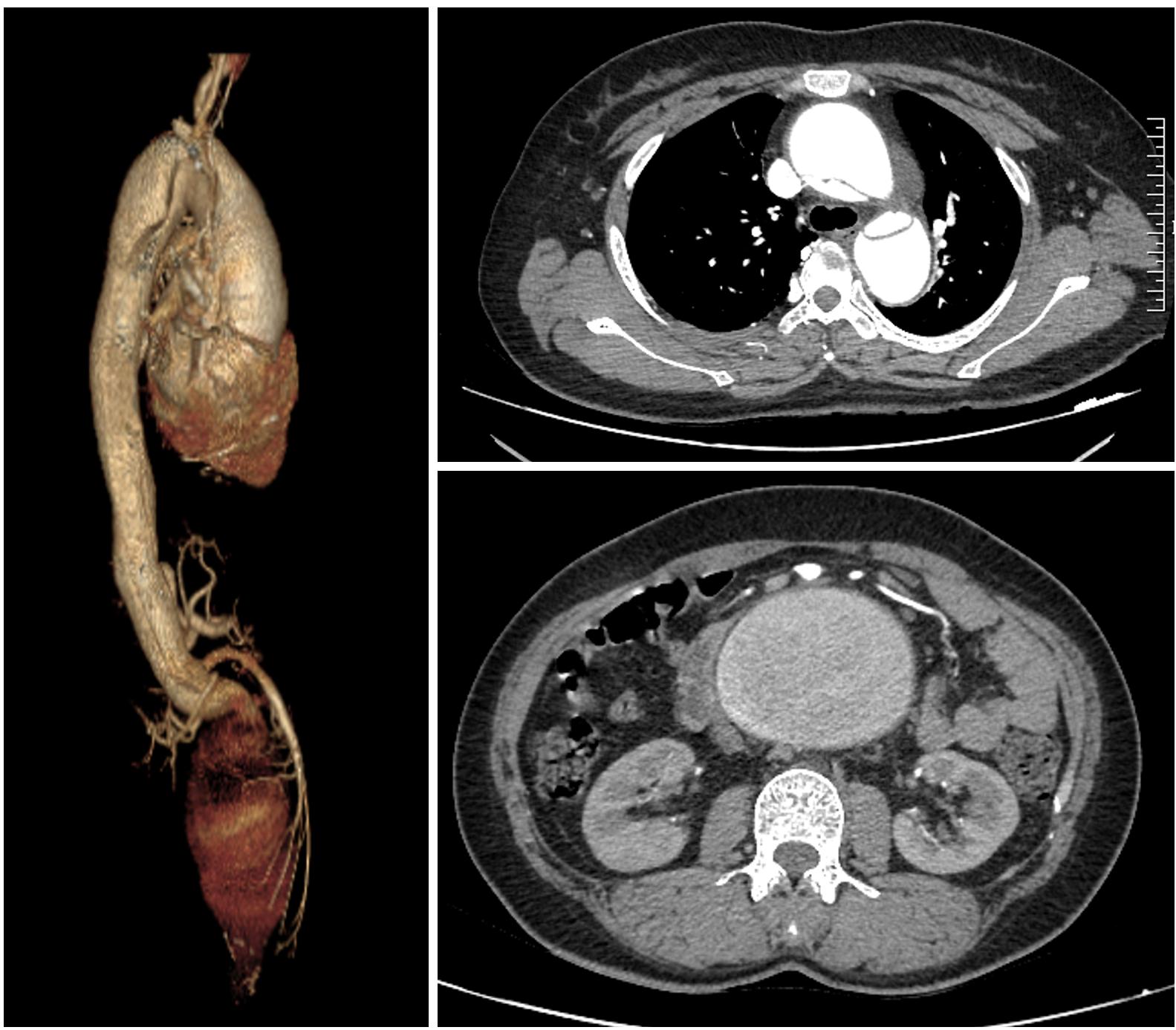 创造生命奇迹：近 1 米长的人体大动脉血管被全部替换