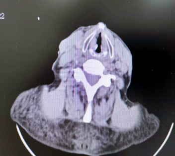 揪心!77 岁慢阻肺患者声音嘶哑,祸首竞是喉癌