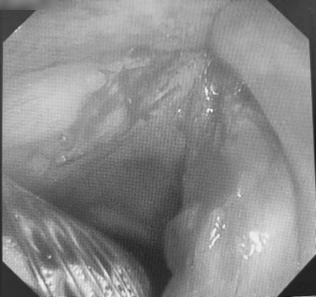 揪心!77 岁慢阻肺患者声音嘶哑,祸首竞是喉癌