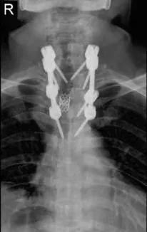 肩膀疼痛竟是肿瘤转移，瘤子侵占胸椎椎管 90%，他要怎么办？