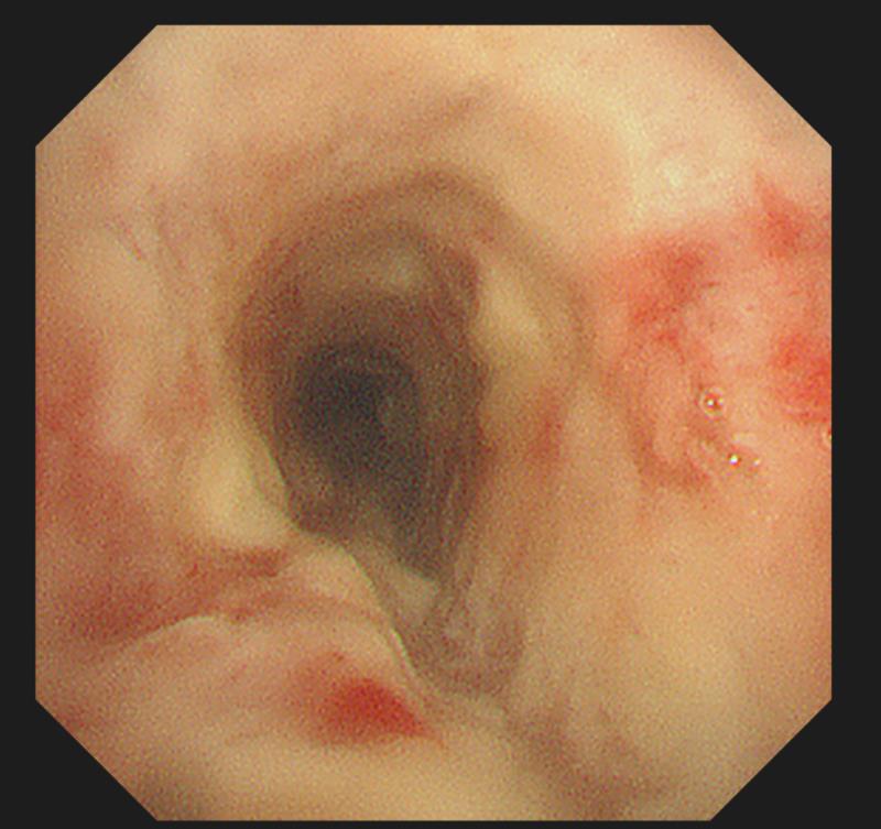 疏忽了人体这个求救信号 小姑娘 6 年后 一病不能说话