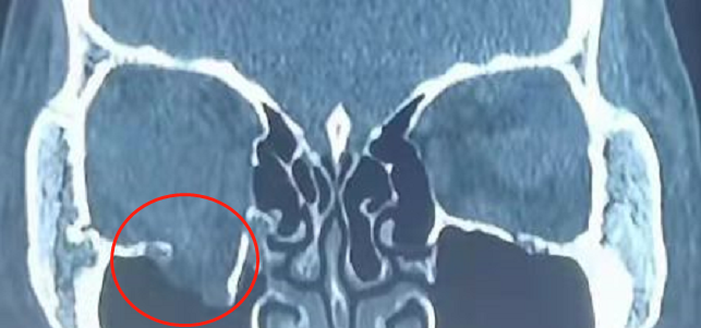 高处摔伤，四肢没事，眼眶这里竟然骨折了