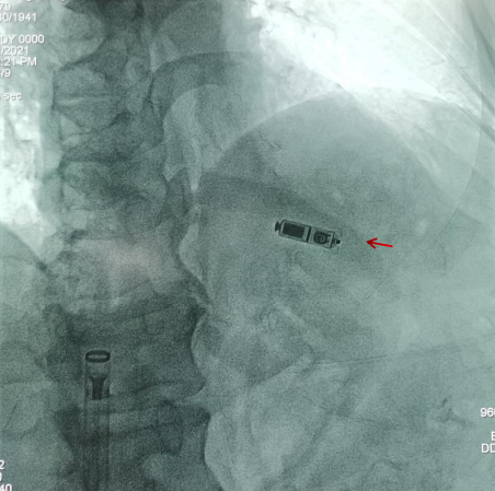 心血管内科一区成功开展我院首例经导管无导线心脏起搏器植入术