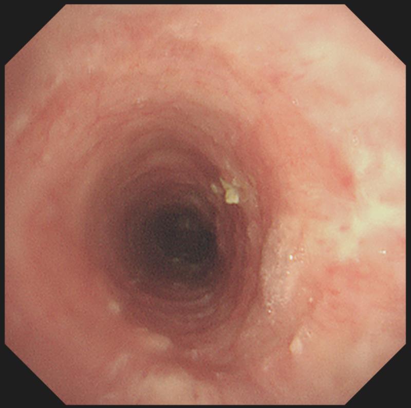 疏忽了人体这个求救信号 小姑娘 6 年后 一病不能说话