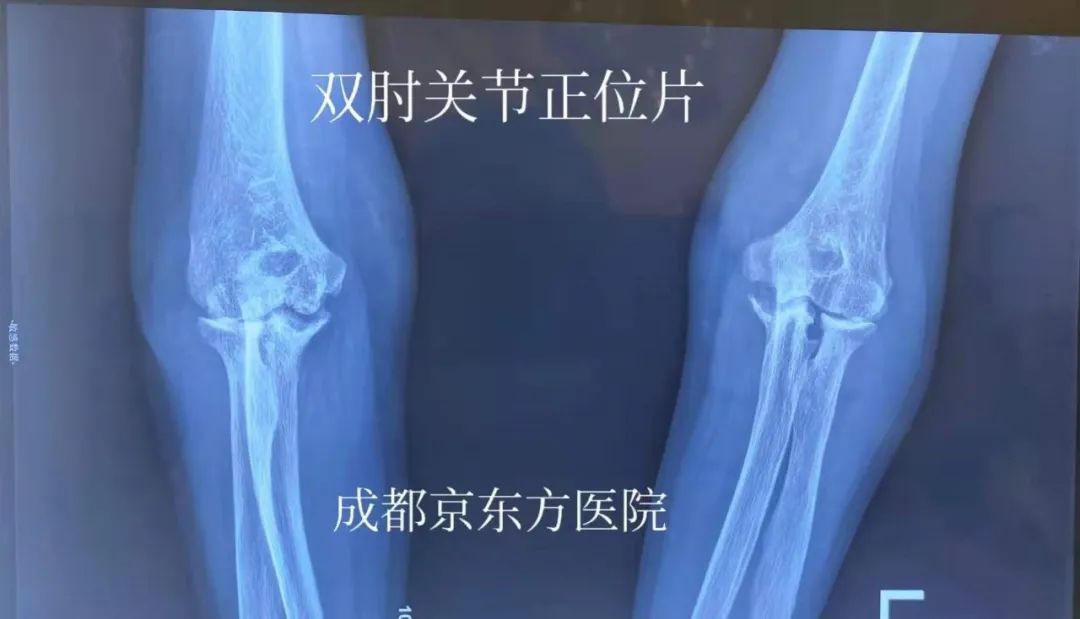 成都京东方医院首例双侧肘关节患者术后康复出院