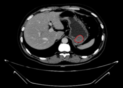突破新记录!胃巨大肿物内镜下被成功切除!