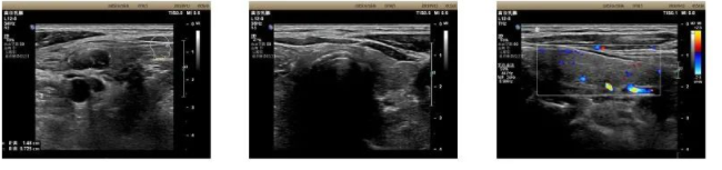 嗜酒如命患上罕见马德龙病，医生从大爷颈部取出大团肿瘤