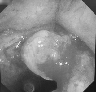 揪心!77 岁慢阻肺患者声音嘶哑,祸首竞是喉癌