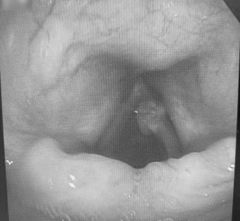 揪心!77 岁慢阻肺患者声音嘶哑,祸首竞是喉癌