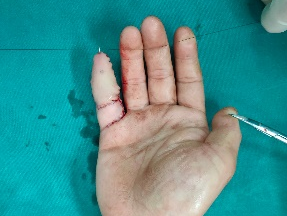 男子小拇指重伤，医生「移花接木」完美修复