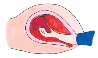 胎盘植入示意图图片