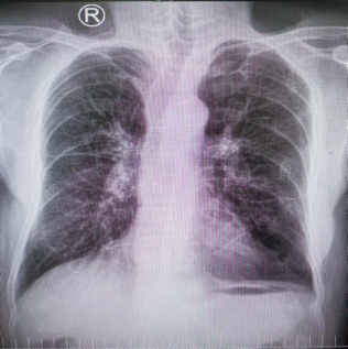 揪心!77 岁慢阻肺患者声音嘶哑,祸首竞是喉癌