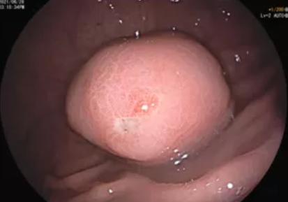 突破新记录!胃巨大肿物内镜下被成功切除!