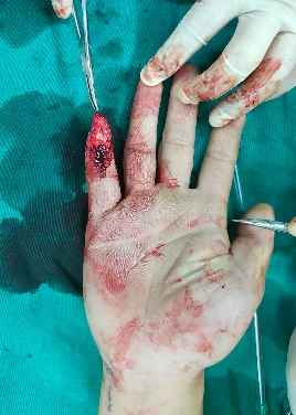 男子小拇指重伤，医生「移花接木」完美修复