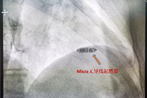 桂林医学院附属医院心血管内科二病区为 90 岁高龄老人成功植入全球最小心脏永久起搏器