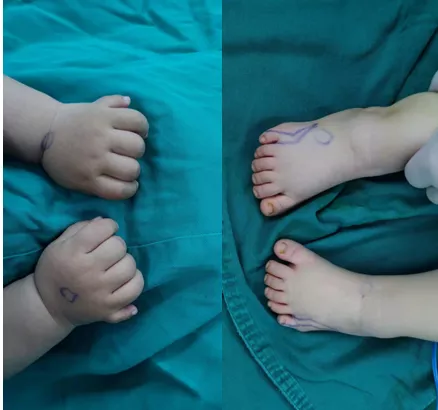 1 岁宝宝双手双足多指、趾畸形，医生巧施手术「切指」成功！