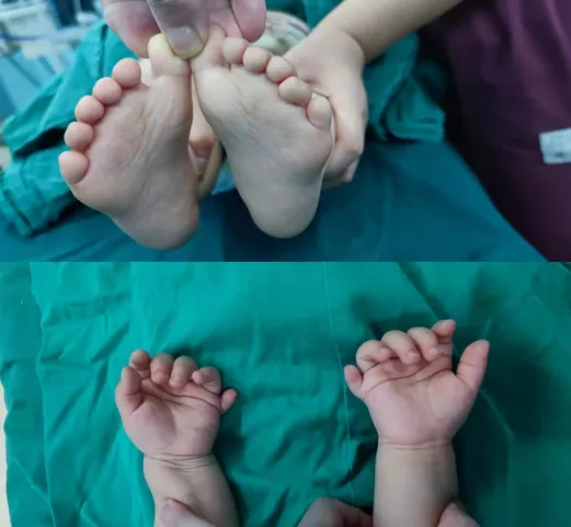 1 岁宝宝双手双足多指、趾畸形，医生巧施手术「切指」成功！