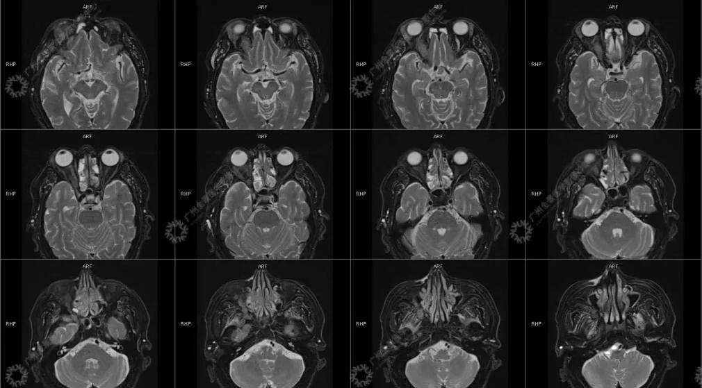 一种极易与肿瘤混淆的「怪病」