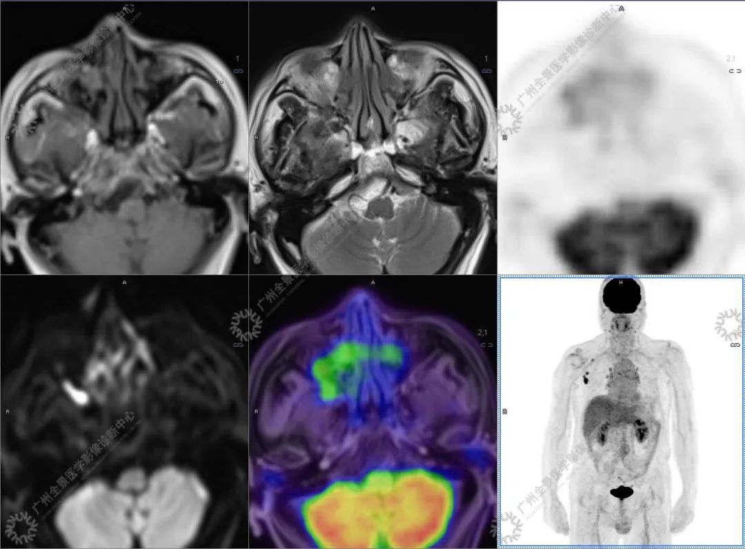 一种极易与肿瘤混淆的「怪病」