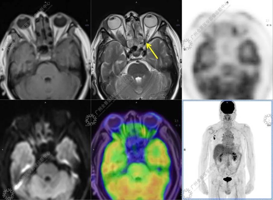 一种极易与肿瘤混淆的「怪病」