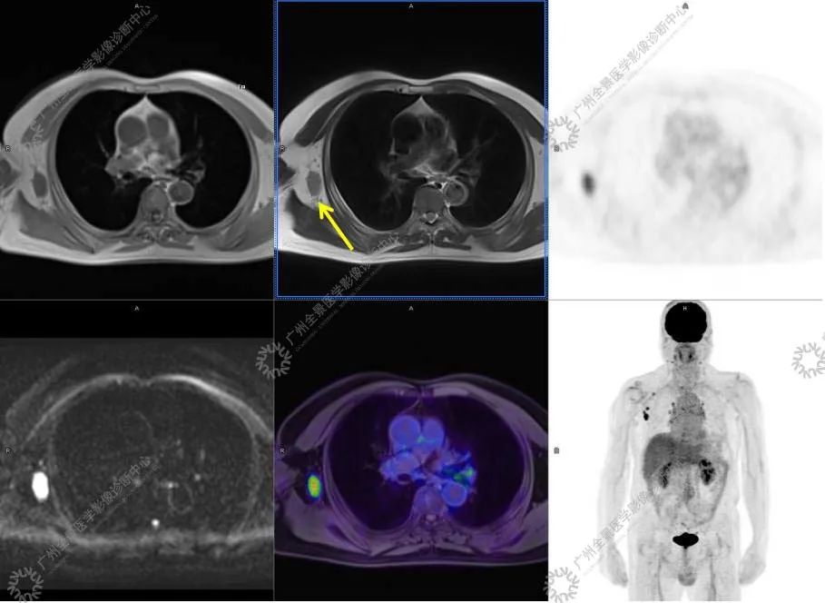一种极易与肿瘤混淆的「怪病」