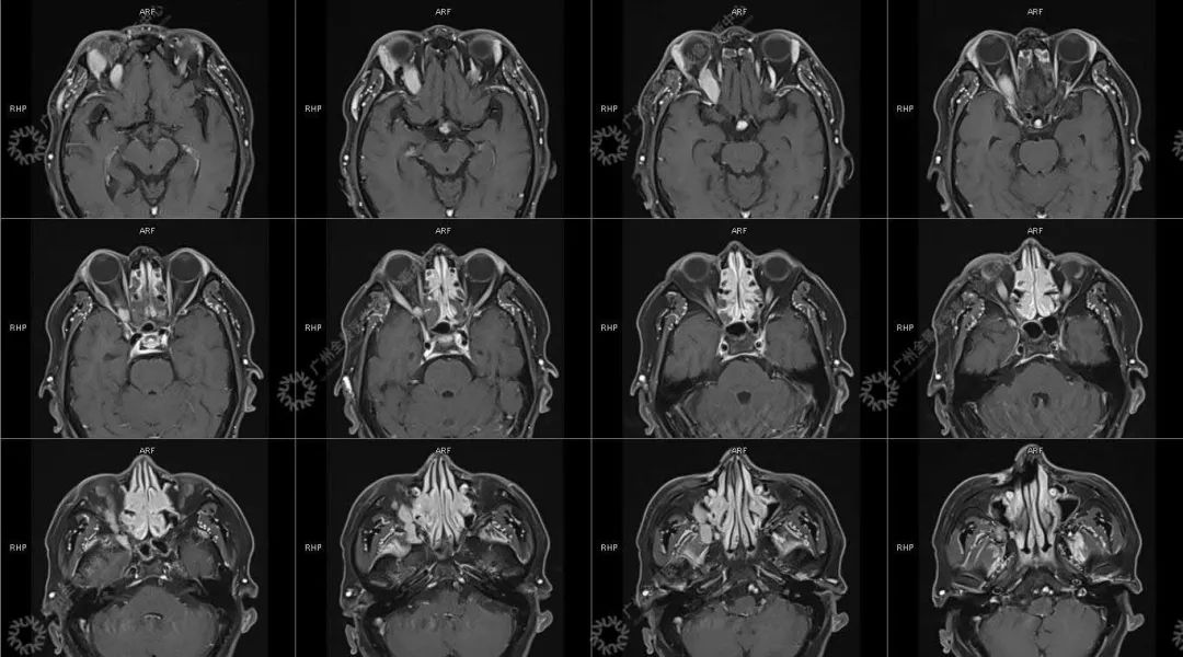 一种极易与肿瘤混淆的「怪病」