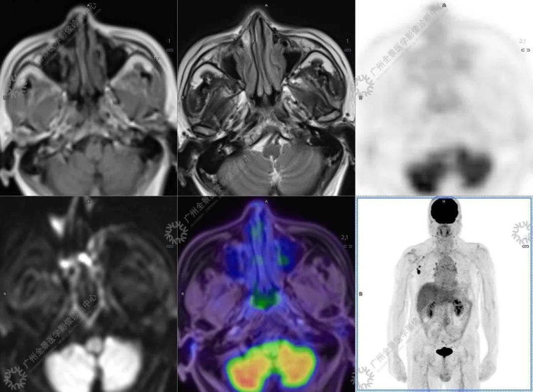 一种极易与肿瘤混淆的「怪病」