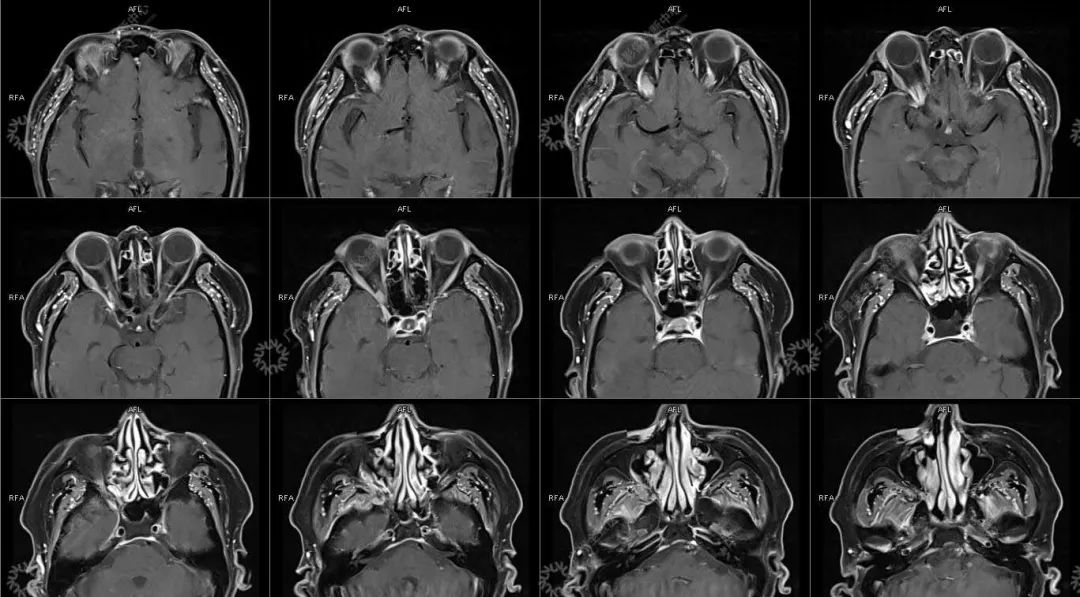 一种极易与肿瘤混淆的「怪病」