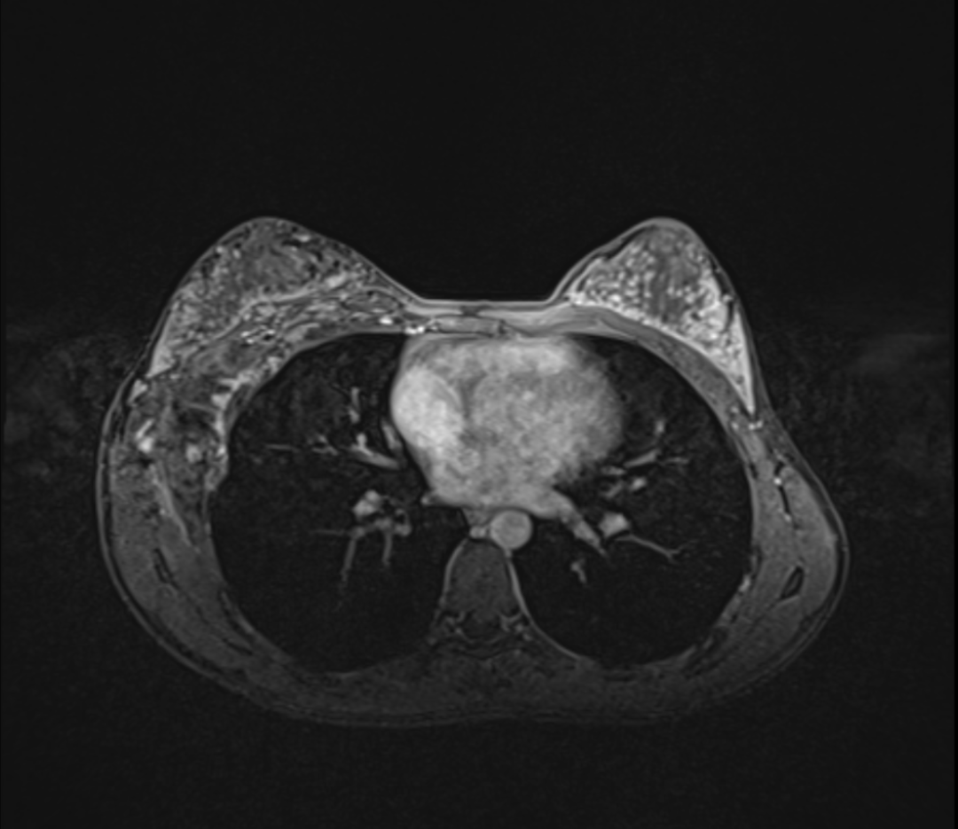 高尚病例:乳腺海绵状血管瘤