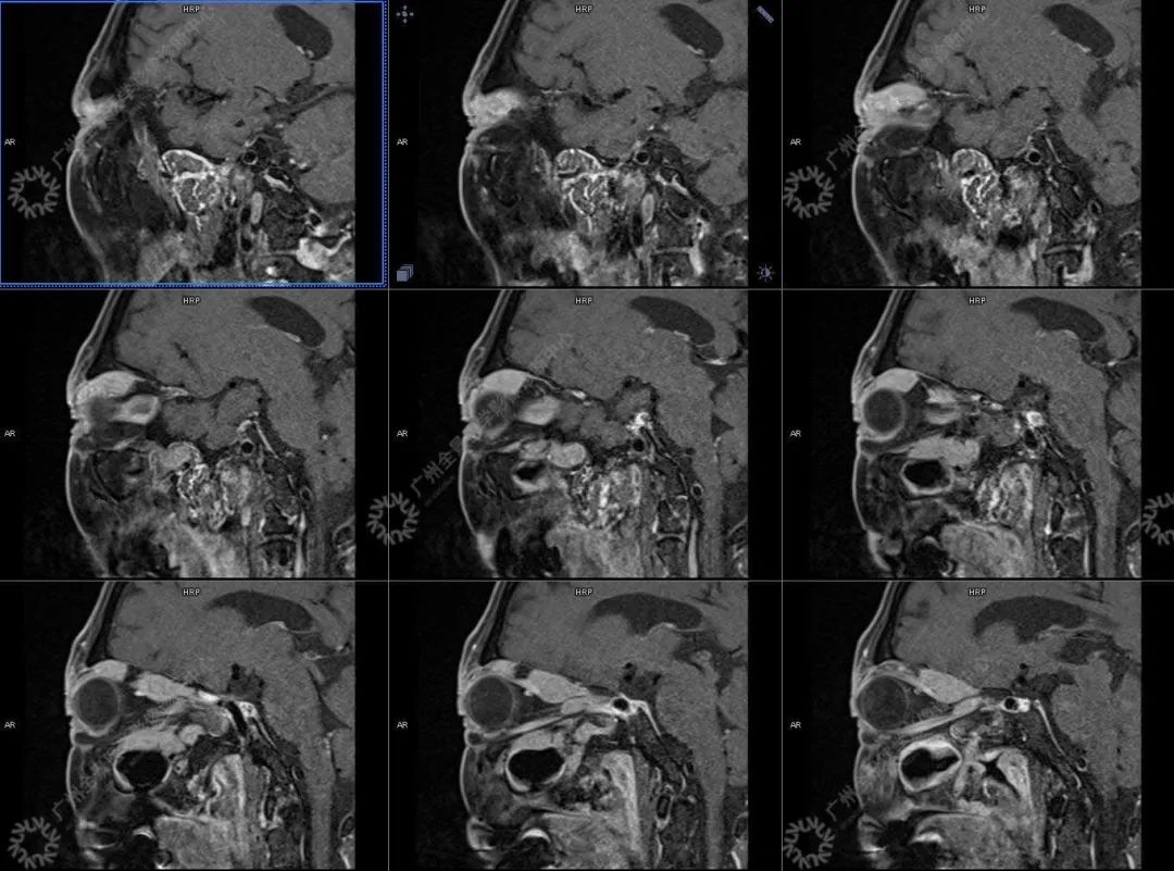 一种极易与肿瘤混淆的「怪病」