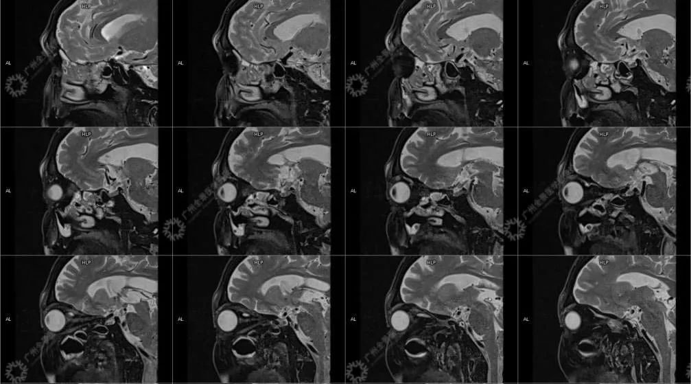 一种极易与肿瘤混淆的「怪病」