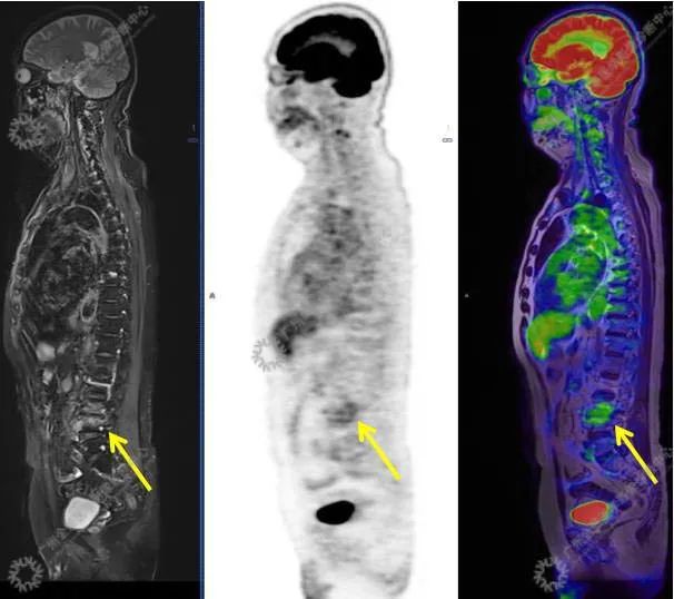 一种极易与肿瘤混淆的「怪病」