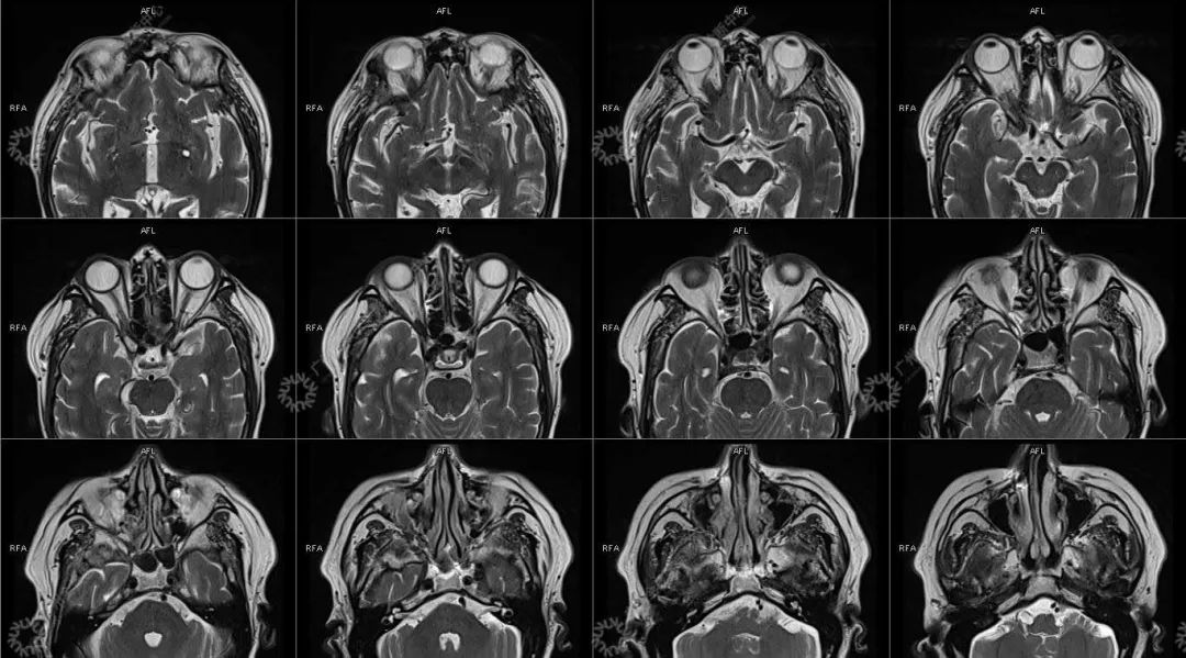 一种极易与肿瘤混淆的「怪病」