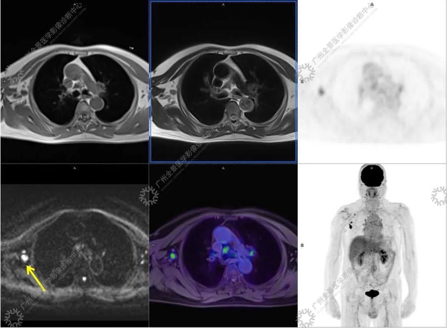 一种极易与肿瘤混淆的「怪病」