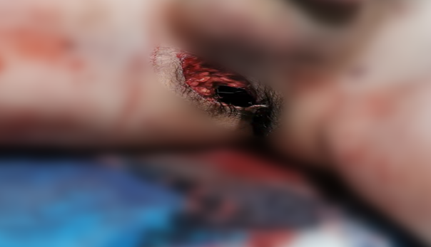 27 岁,男,新婚,一场车祸竟伤在私密部位