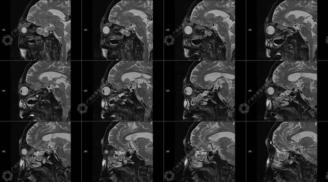 一种极易与肿瘤混淆的「怪病」