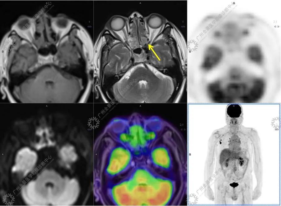 一种极易与肿瘤混淆的「怪病」
