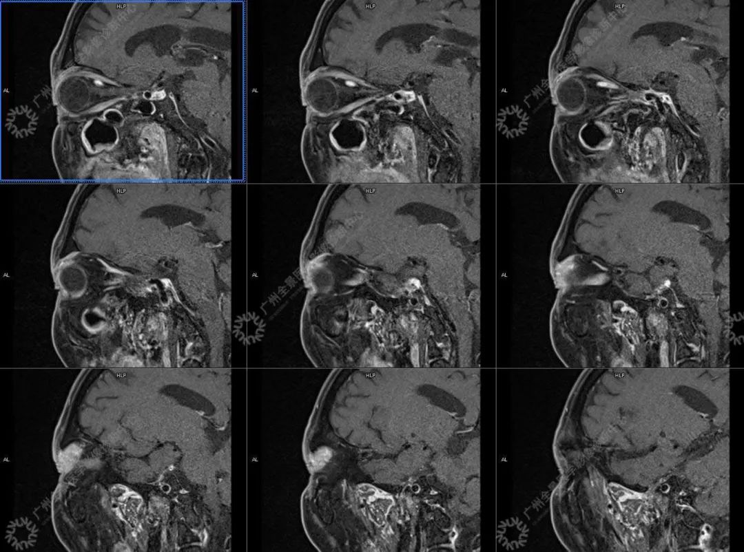 一种极易与肿瘤混淆的「怪病」