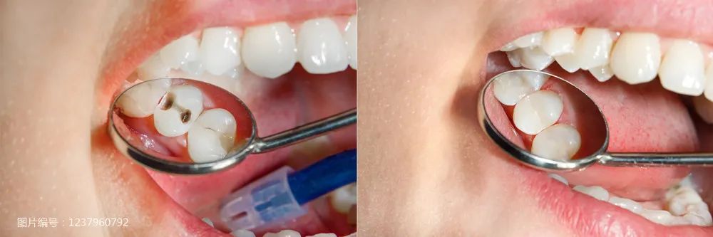 明明是去补牙，为什么「缺德」牙医却把牙洞越磨越大？