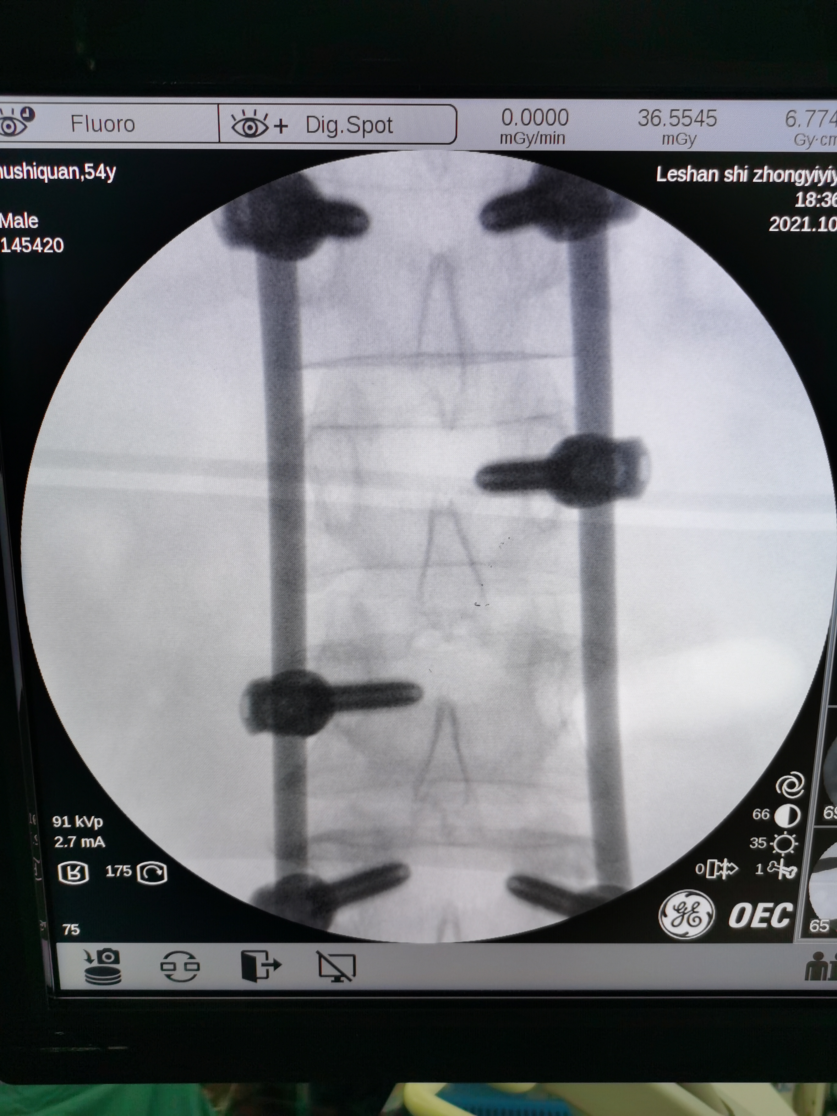 乐山市中医医院开展全市首例多节段胸腰椎骨折经皮微创手术