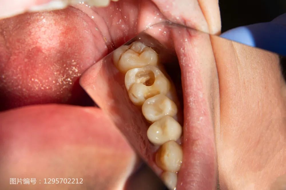 明明是去补牙，为什么「缺德」牙医却把牙洞越磨越大？