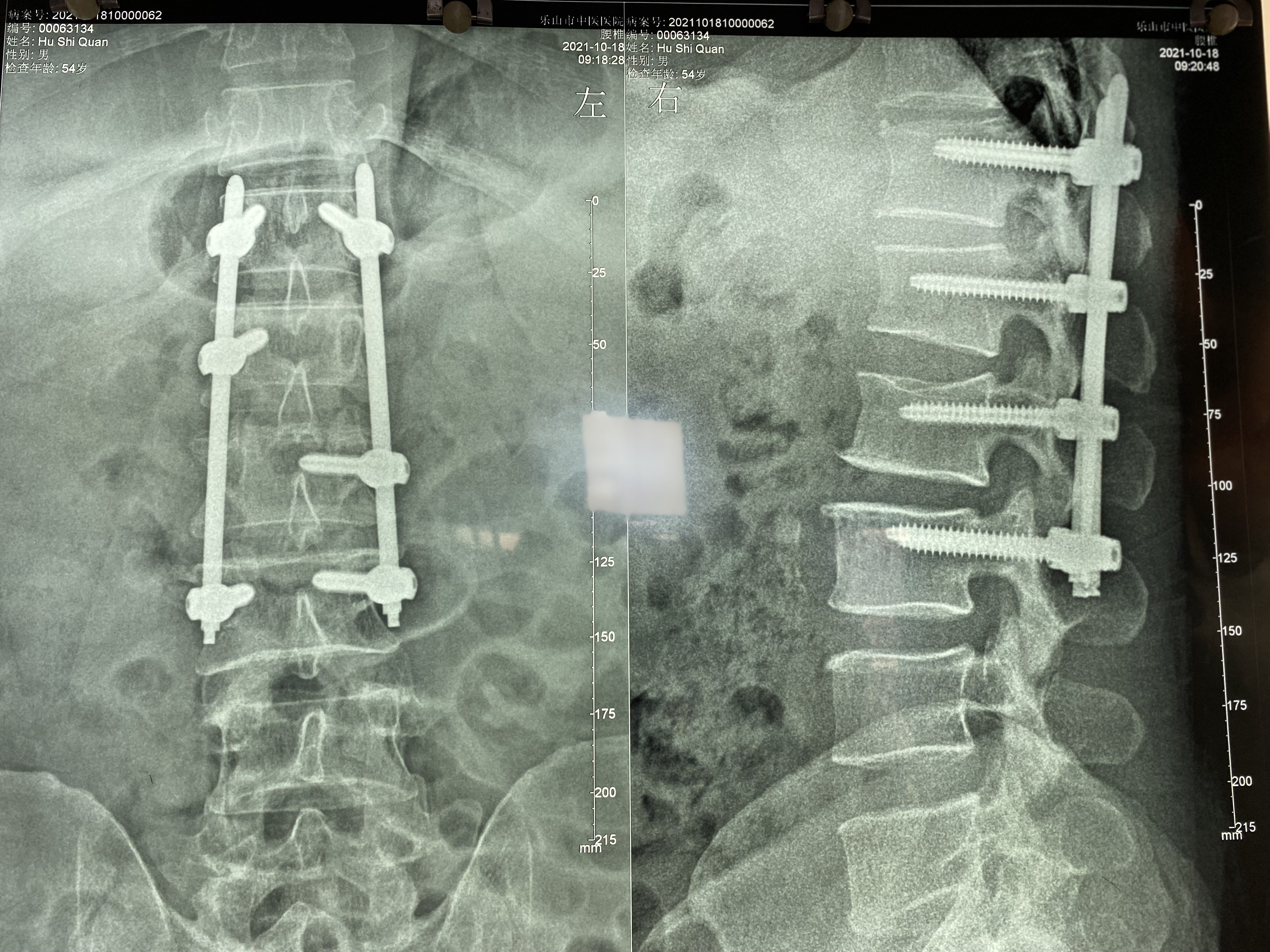 乐山市中医医院开展全市首例多节段胸腰椎骨折经皮微创手术