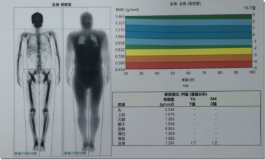 骨质疏松竟与痴呆有关？