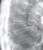 骨质疏松竟与痴呆有关？