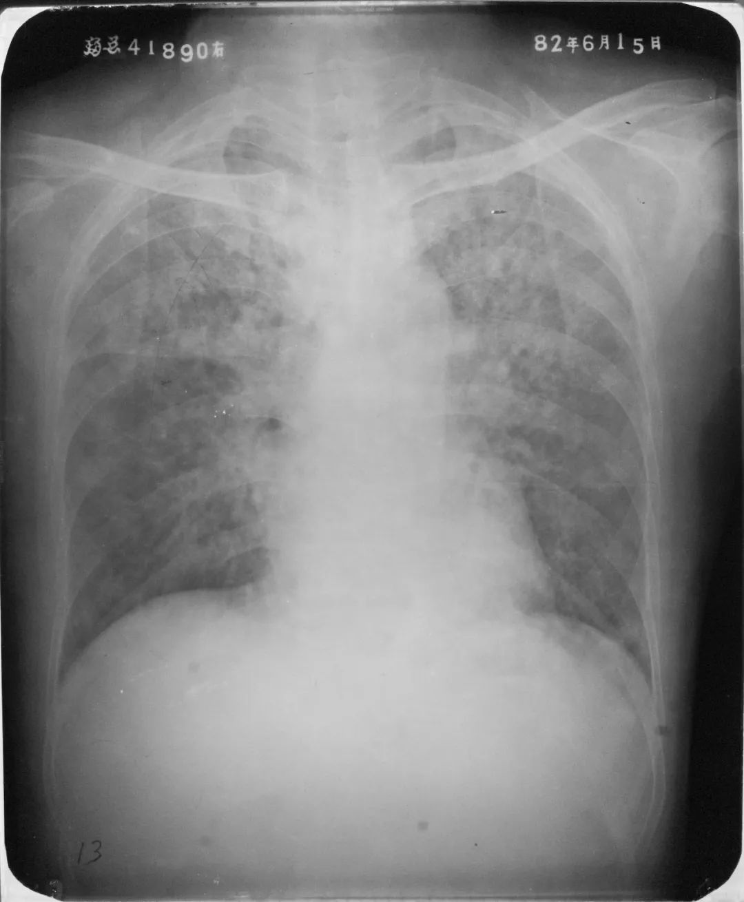胸部 X 线检查显示肺淤血