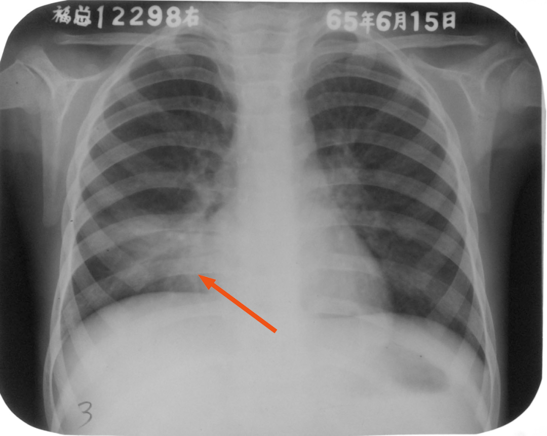 10岁孩子得了肺炎，最后却手术切除了部分肺组织！