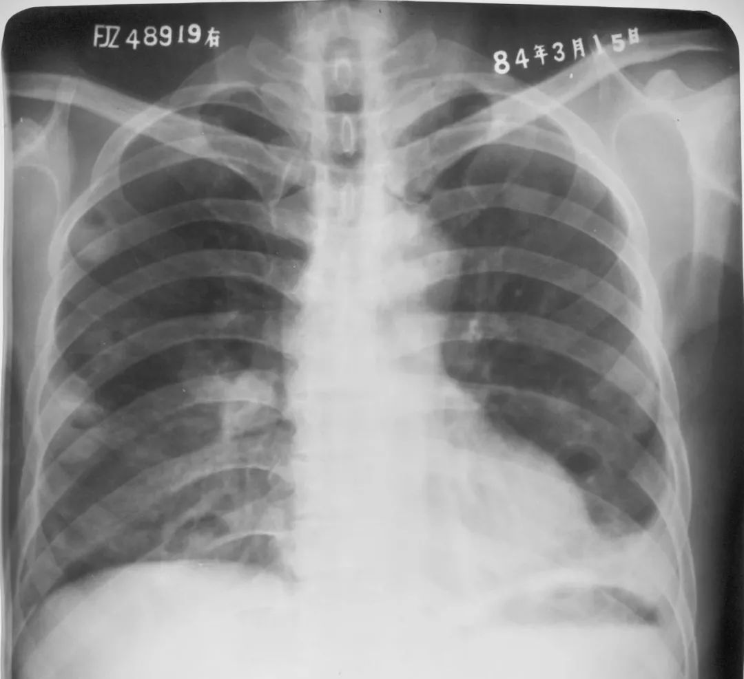哈医大二院胸外科经典病例之右肺中叶切除术后左肺S1+2切除术 - 好大夫在线